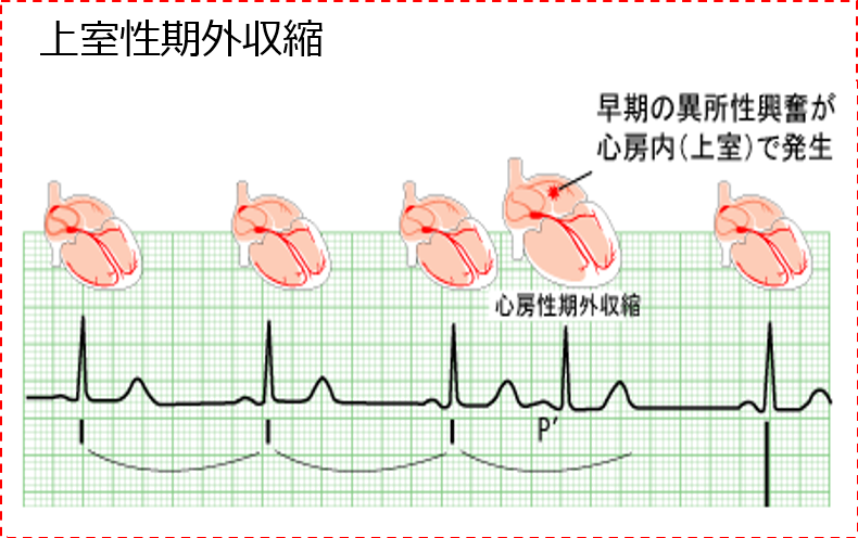 上室性期外収縮